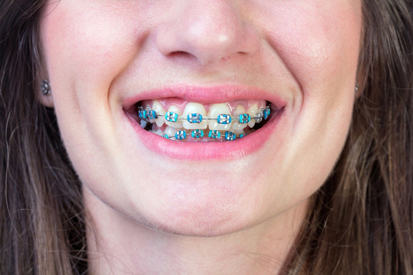 What Colour of Dental Braces Should You Choose? | iPodcast
