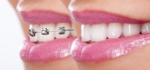 Teeth With Braces