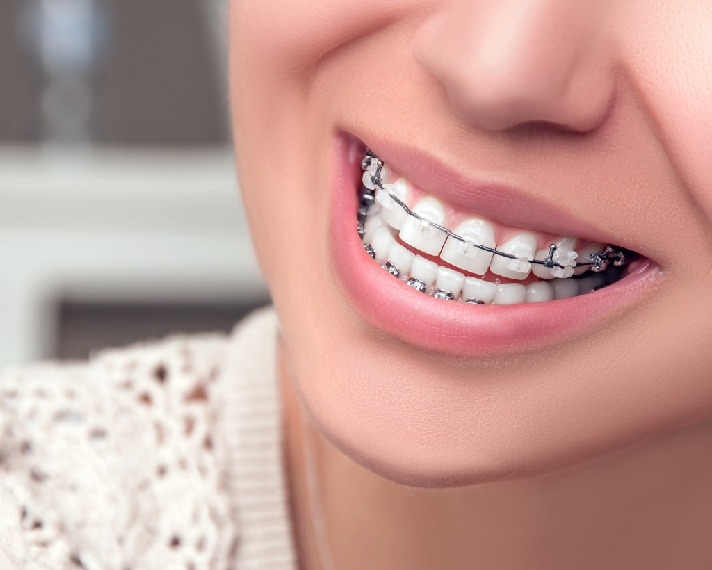 How Cosmetic Braces Can Give You The Beautifully Aligned Smile Youve Always Wanted In A 
