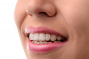 Woman wearing her invisalign
