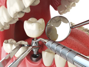Concept of dental implant