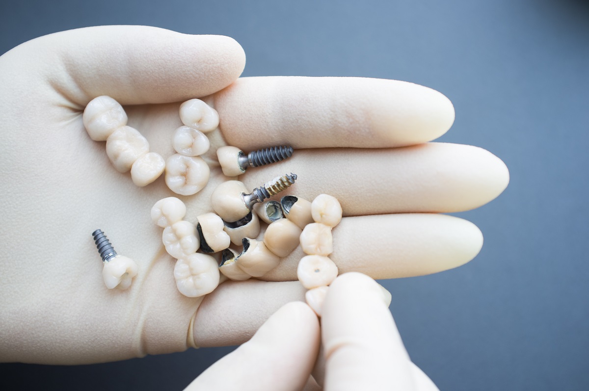 Lifestyle Factors and Dental Implants