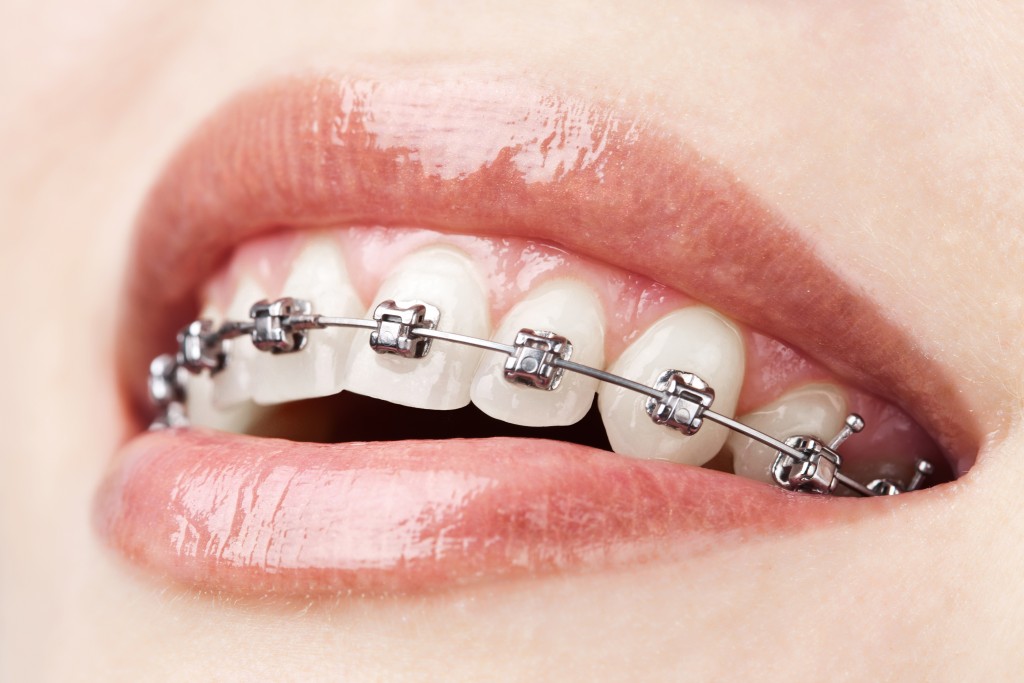 Dental Braces: Are Straight Teeth Everything?