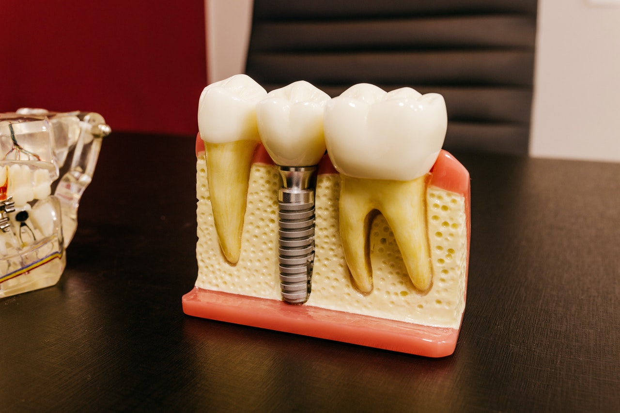model of dental implants