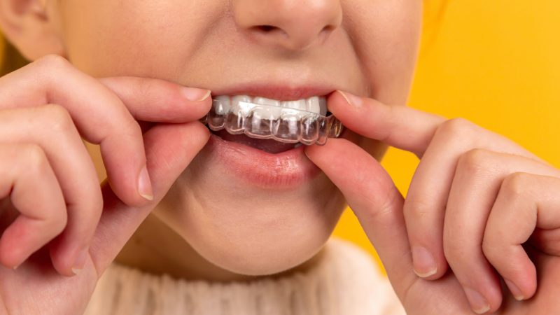 Looking for a solution to misaligned teeth? Invisalign W1 could be it