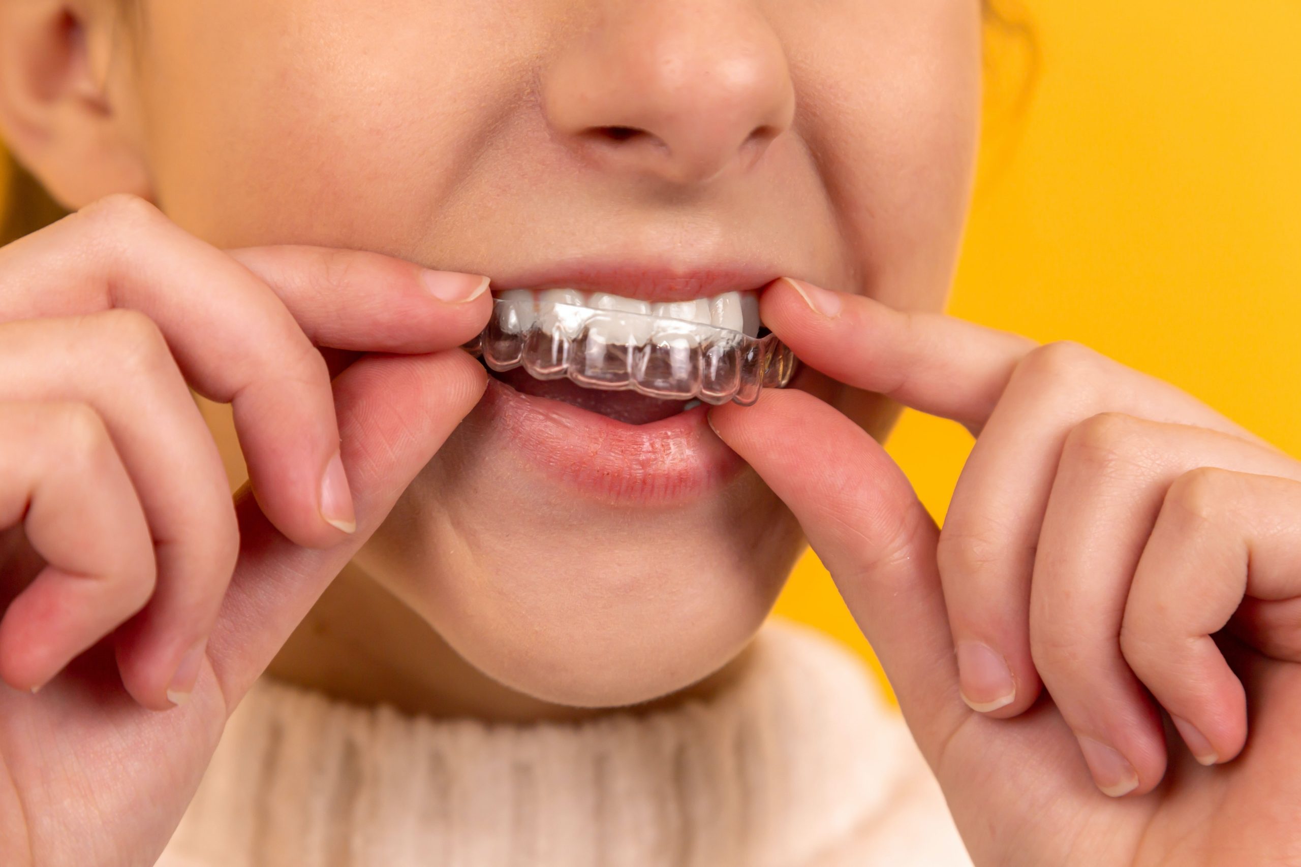 Looking for a solution to misaligned teeth? Invisalign W1 could be it