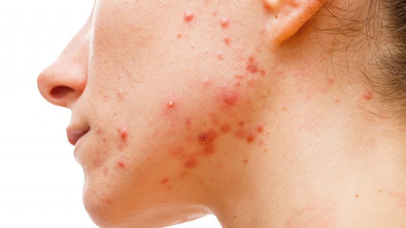 Seven of the Best Ways to Avoid Acne
