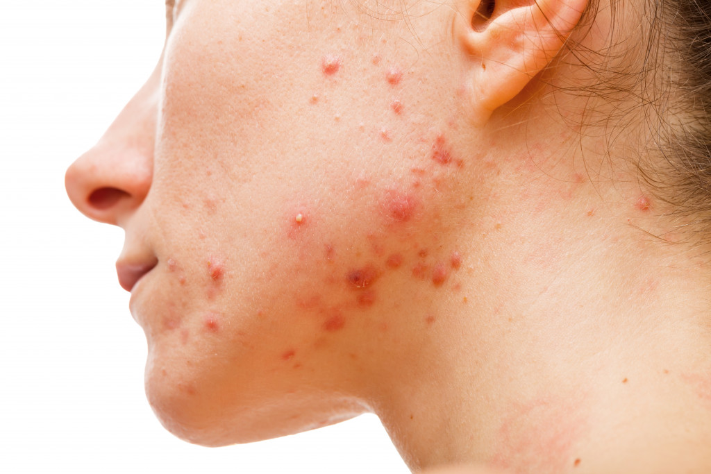 Seven of the Best Ways to Avoid Acne